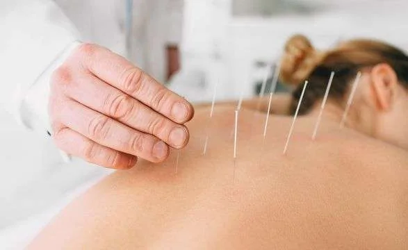 Fine acupuncture needles placed along a patient’s back